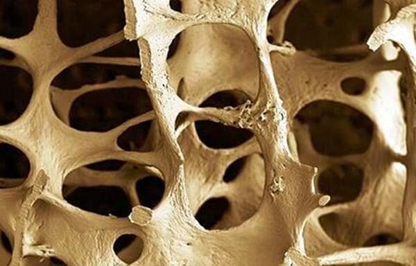 Detail kosti postihnutej osteoporózou