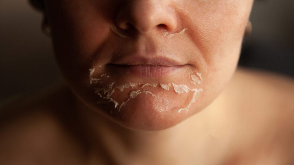 Detailný záber na tvár ženy, ktorá podstupuje účinný chemický peeling